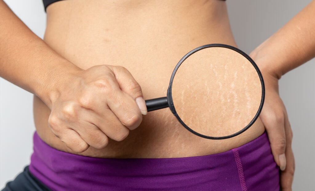 lady holding magnifying glass to magnify stretch marks